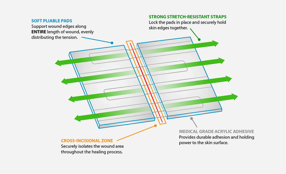 Clozex: Simple and Secure Wound Closure Solution